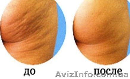 Вакуумный аппаратный антицеллюлитный массаж с выездом к Вам домой - <ro>Изображение</ro><ru>Изображение</ru> #1, <ru>Объявление</ru> #812257