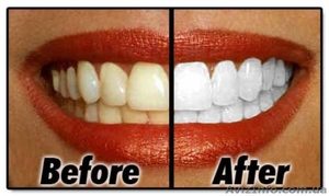 Отбеливание зубов с помощью Crest Whitestrips, Одесса - <ro>Изображение</ro><ru>Изображение</ru> #2, <ru>Объявление</ru> #1296474